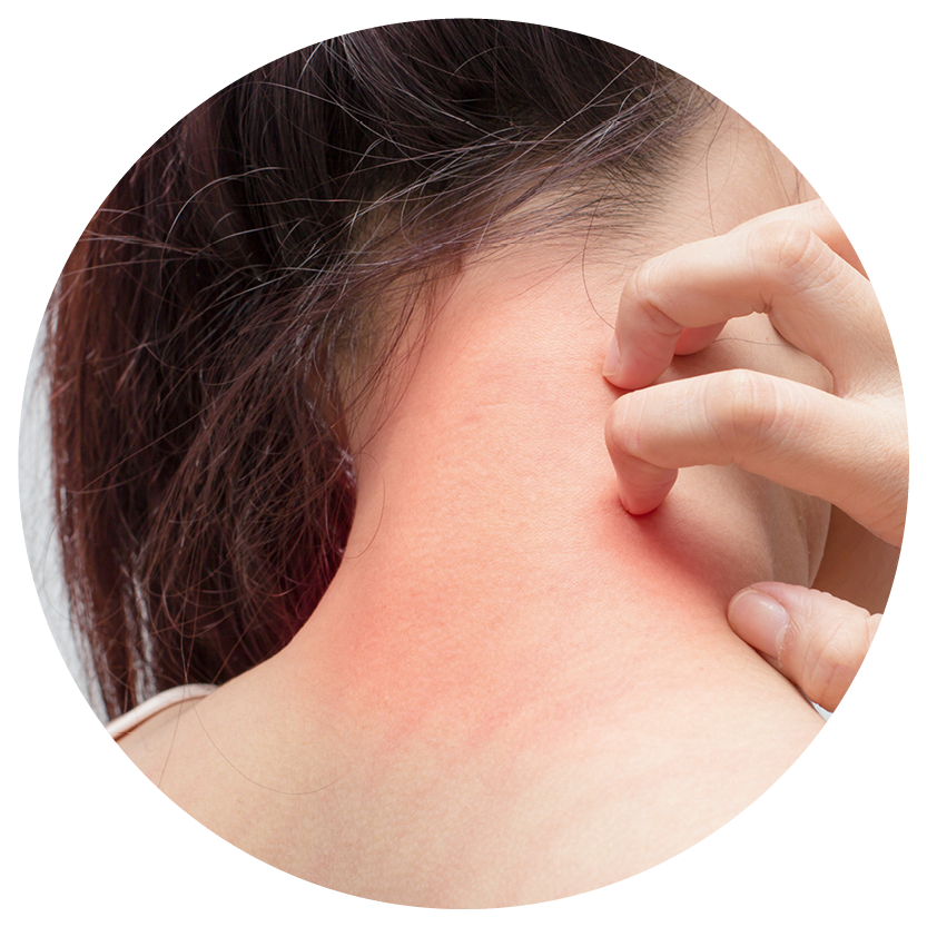 Neurodermitis am Hals